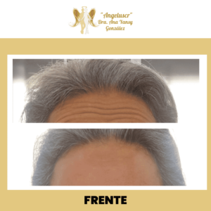 Angeluscr by Dra. Ana Yansy González Clinica Medica Estetica #1 Costa Rica 16