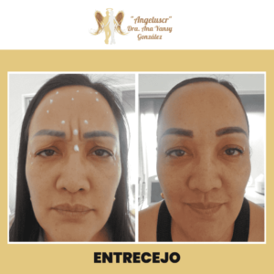 Angeluscr by Dra. Ana Yansy González Clinica Medica Estetica #1 Costa Rica 18