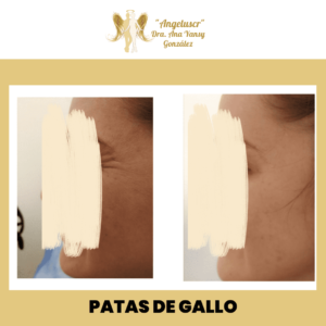 Angeluscr by Dra. Ana Yansy González Clinica Medica Estetica #1 Costa Rica 17
