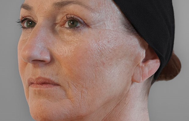 Ellansé Bioestimulador Clinica Medica Estetica Costa Rica 2