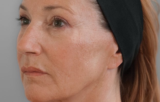 Ellansé Bioestimulador Clinica Medica Estetica Costa Rica 3