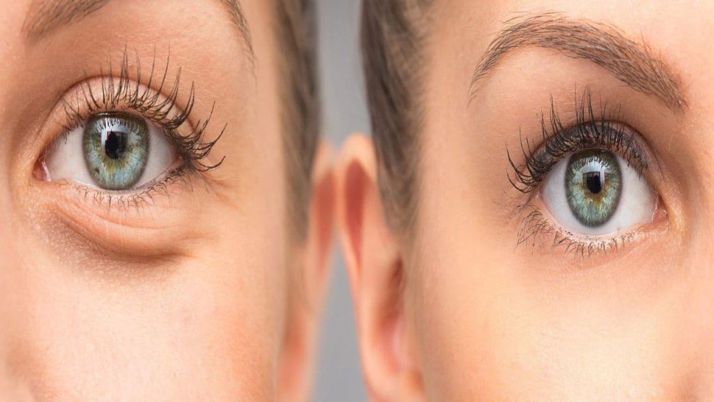 Filler de Acido Hialurónico en ojeras hundidas angeluscr clinica medicina estetica costa rica1